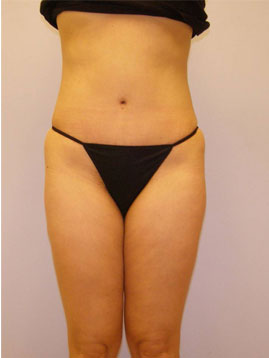 Tummy Tuck Before & After Image