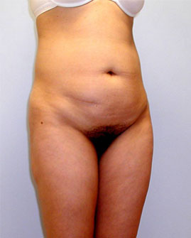 Tummy Tuck Before & After Image