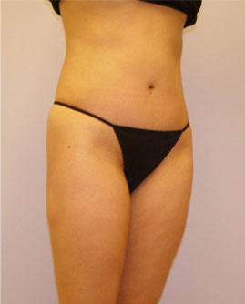 Tummy Tuck Before & After Image