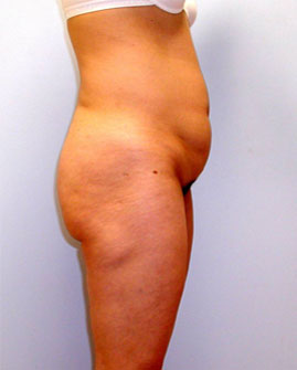 Tummy Tuck Before & After Image