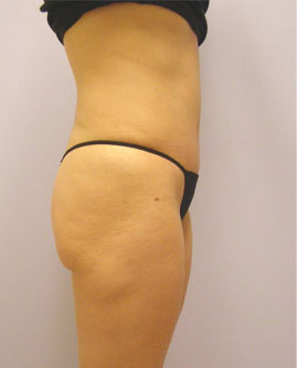 Tummy Tuck Before & After Image