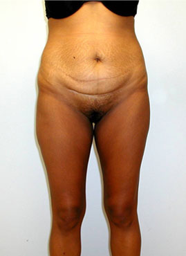 Tummy Tuck Before & After Image