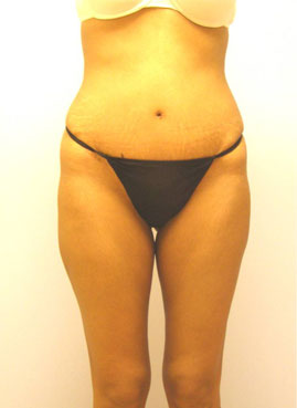 Tummy Tuck Before & After Image