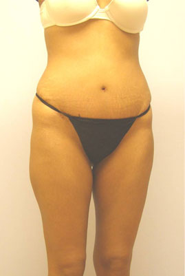 Tummy Tuck Before & After Image