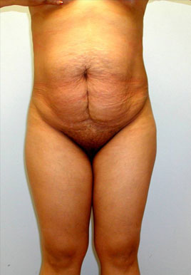 Tummy Tuck Before & After Image