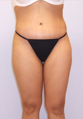 Tummy Tuck Before & After Image