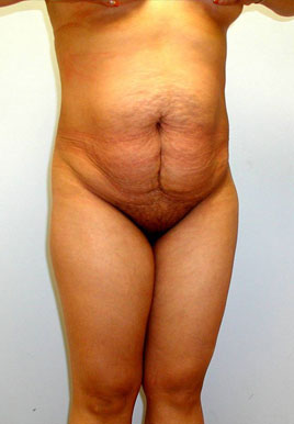 Tummy Tuck Before & After Image