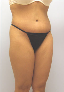 Tummy Tuck Before & After Image