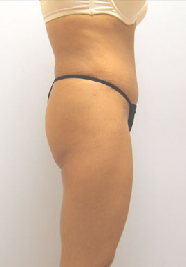 Tummy Tuck Before & After Image