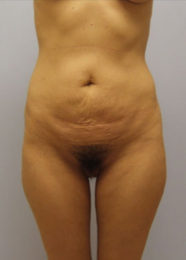 Tummy Tuck Before & After Image