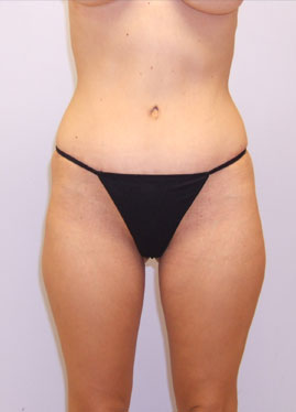 Tummy Tuck Before & After Image