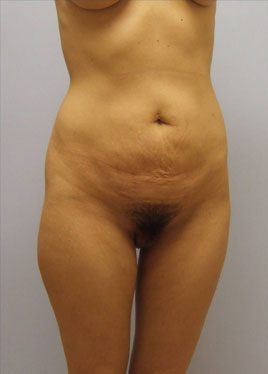 Tummy Tuck Before & After Image