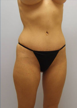 Tummy Tuck Before & After Image