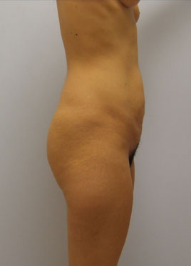 Tummy Tuck Before & After Image