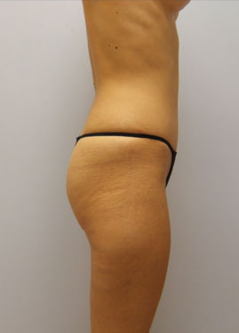 Tummy Tuck Before & After Image