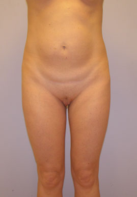 Tummy Tuck Before & After Image