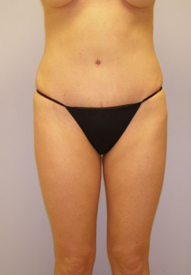 Tummy Tuck Before & After Image