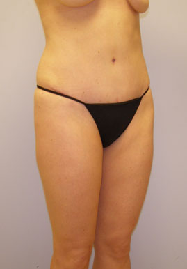 Tummy Tuck Before & After Image