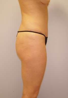 Tummy Tuck Before & After Image