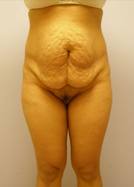 Tummy Tuck Before & After Image