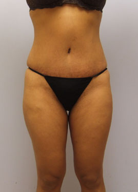 Tummy Tuck Before & After Image