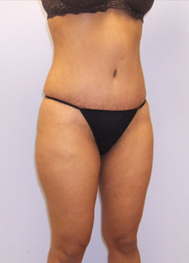 Tummy Tuck Before & After Image