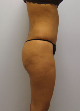 Tummy Tuck Before & After Image