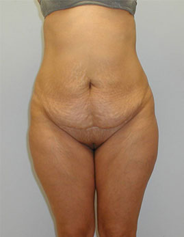 Tummy Tuck Before & After Image