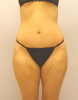 Tummy Tuck Before & After Image