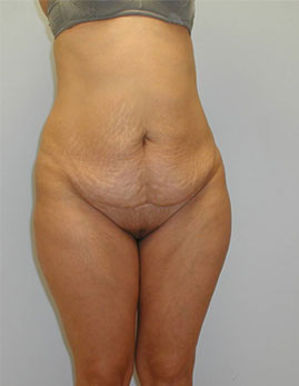 Tummy Tuck Before & After Image