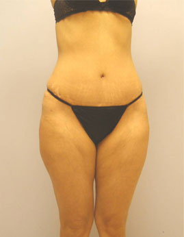 Tummy Tuck Before & After Image