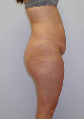 Tummy Tuck Before & After Image