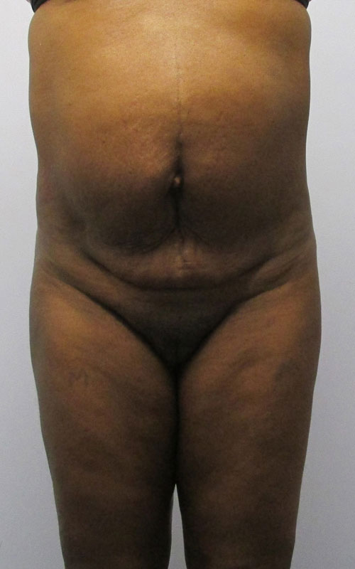 Tummy Tuck Before & After Image