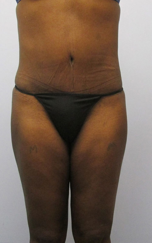 Tummy Tuck Before & After Image