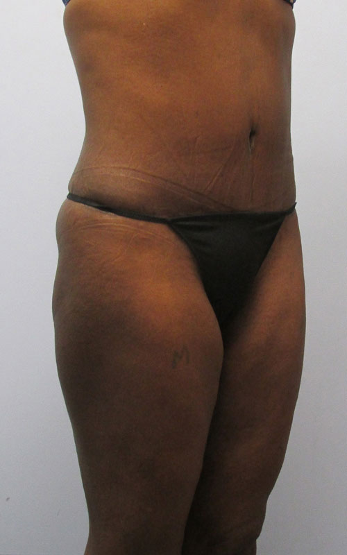 Tummy Tuck Before & After Image