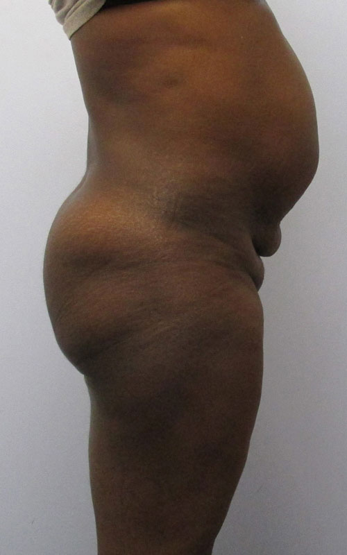 Tummy Tuck Before & After Image