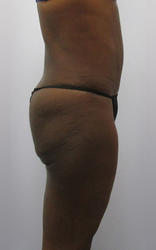 Tummy Tuck Before & After Image