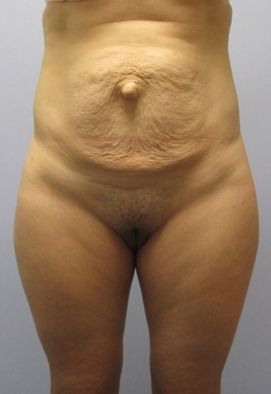 Tummy Tuck Before & After Image