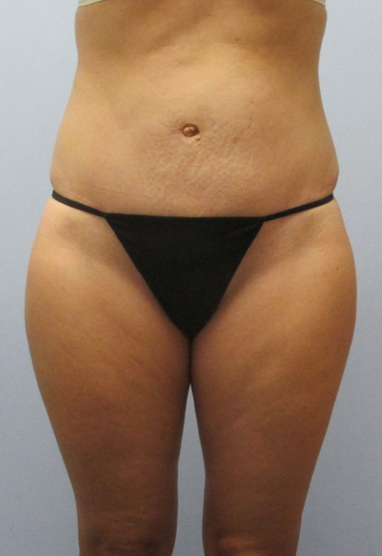 Tummy Tuck Before & After Image