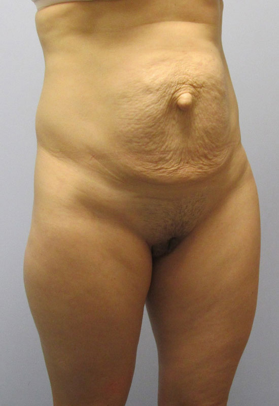 Tummy Tuck Before & After Image