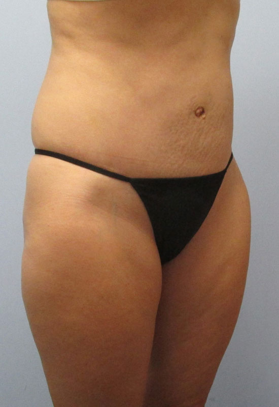 Tummy Tuck Before & After Image