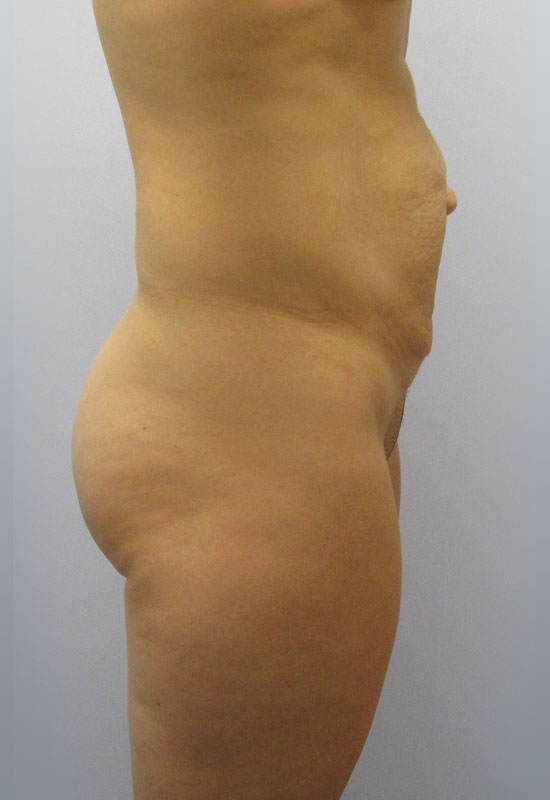 Tummy Tuck Before & After Image