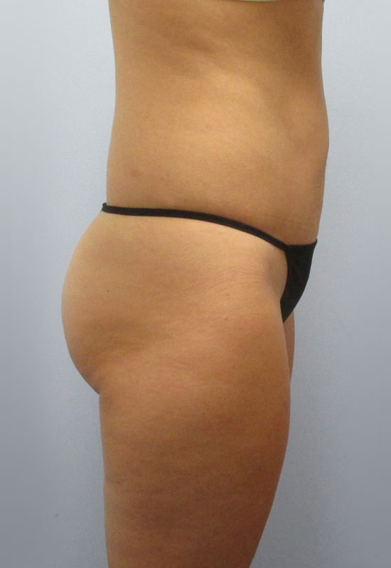 Tummy Tuck Before & After Image