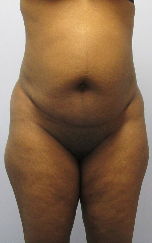 Tummy Tuck Before & After Image