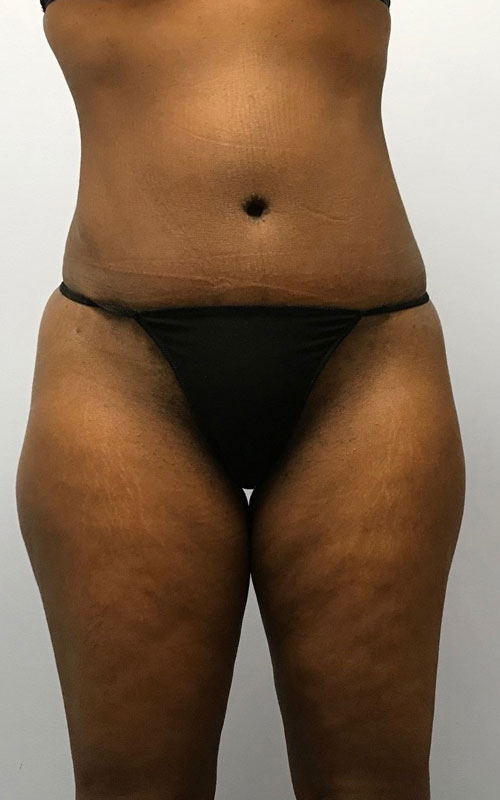 Tummy Tuck Before & After Image