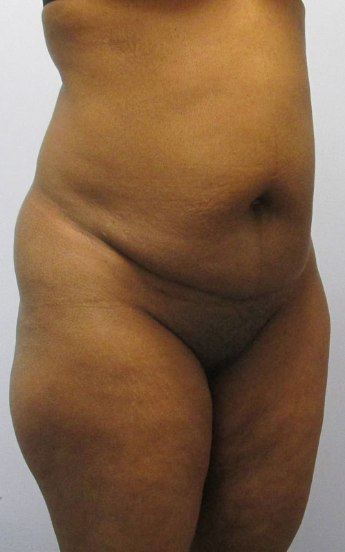 Tummy Tuck Before & After Image