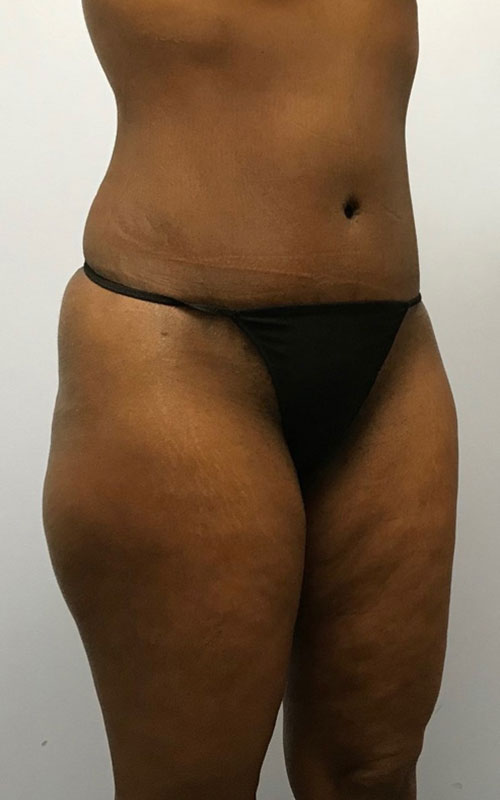 Tummy Tuck Before & After Image