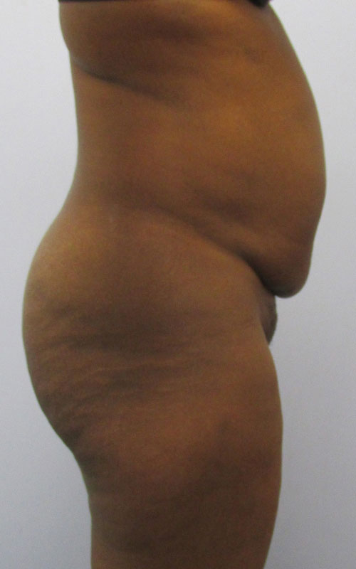 Tummy Tuck Before & After Image