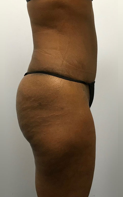 Tummy Tuck Before & After Image