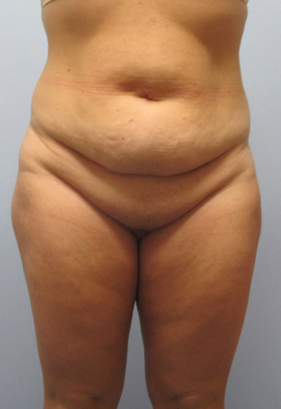 Tummy Tuck Before & After Image